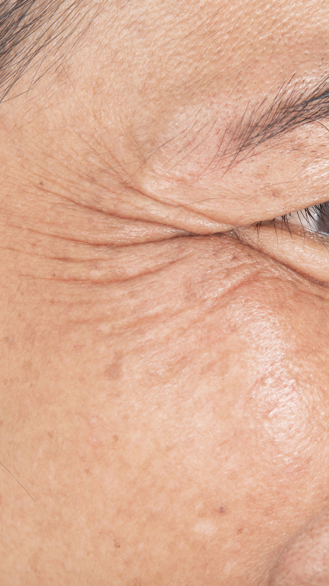 Aging / Wrinkles